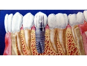 implant.jpg