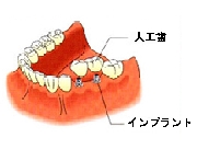 インプラント3.jpg