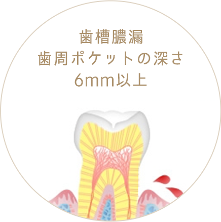 歯槽膿漏歯周ポケットの深さ6mm以上